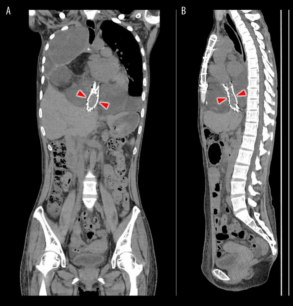 An enhanced CT showed that a stent (triangle) was placed in the IVC between the liver and the heart, sandwiched between the tumors. In addition, subcutaneous tissue edema from the abdomen to both lower extremities was improved. (A) Coronal section; (B) Sagittal section.