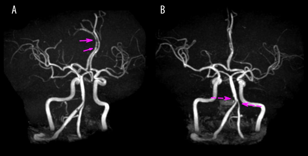 (A) Brain magnetic resonance angiogram showing beaded stenosis in right anterior cerebral artery (arrows). (B) Brain magnetic resonance angiogram showing stenosis in the V4 segment of the vertebral artery (arrows).