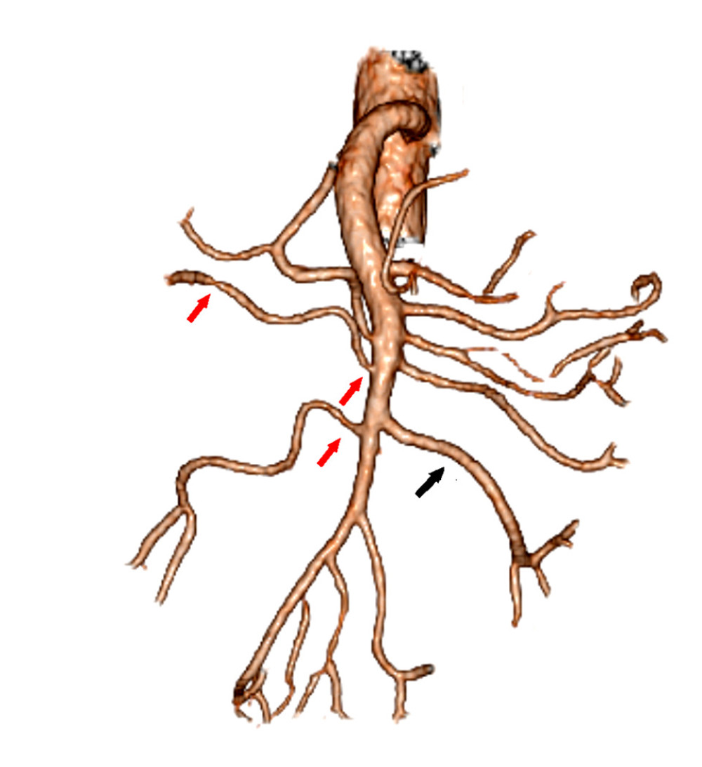 Abdominal computed tomography angiography showing stenosis of the right colic and ileocolic arteries (red arrows). For comparison, we attached the black arrow that indicates an intact branch of the jejunal artery.