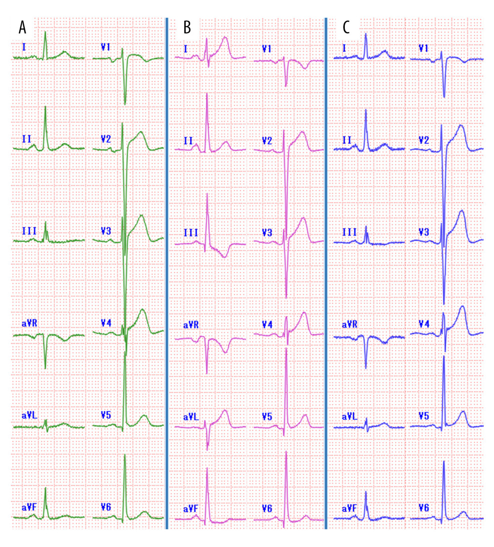 (A) Electrocardiogram recorded at the first visit showing no abnormal findings. (B) Electrocardiogram of the third attack showing remarkable ST-segment elevation in leads I and aVL and inverted T waves in lead III. (C) Electrocardiogram (ECG) after 1.5 h of the third attack showing normalized ECG.