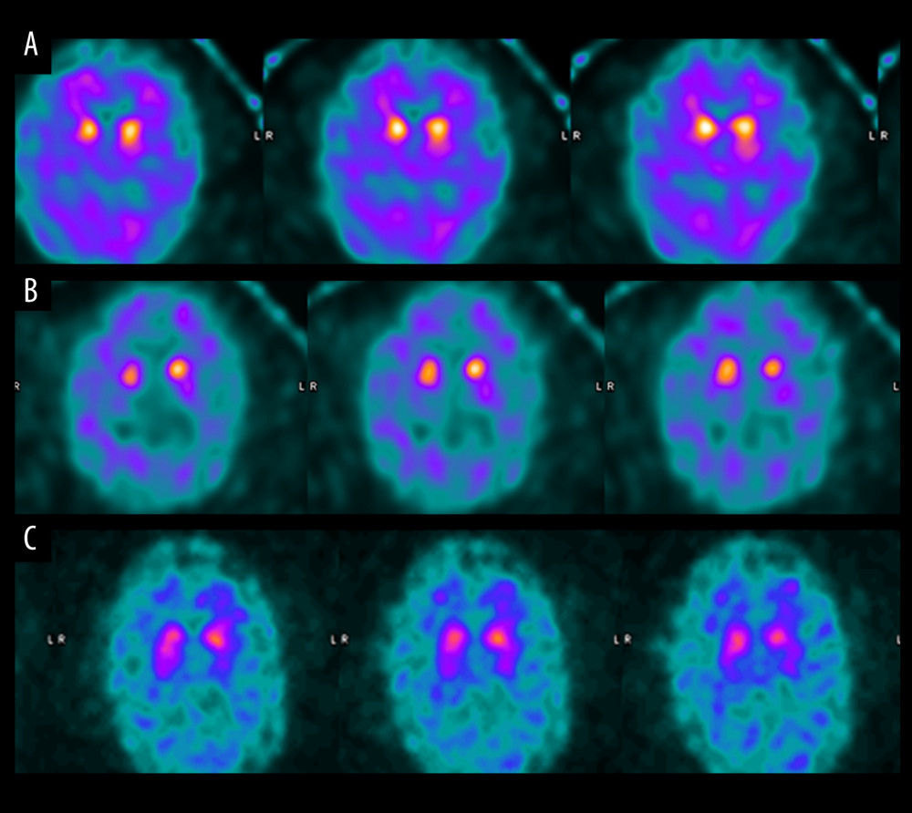 FP-CIT SPECT images of our patients; note the minimal dopamine tracer uptake in all 3 DLB cases, in which tracer uptake was restricted to the caudate with a period or full-stop appearance. Cases are identified as follows: (A) Case 1, (B) Case 2, and (C) Case 3. FP-CIT DLB, dementia with Lewy bodies; FP-CIT SPECT, single-photon emission computerized tomography with the ligand (123)I-2beta-carbometoxy-3beta-(4-iodophenyl)-N-(3-fluoropropyl) nortropane ((123)I-FP-CIT), which binds to the dopamine transporter reuptake site.