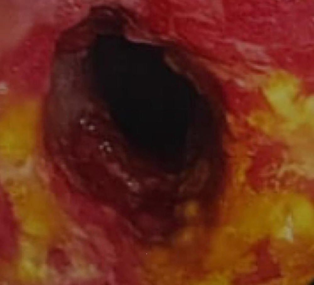 First colonoscopy image at the time of ulcerative colitis diagnosis. The colonic mucosa was friable and intensely erythematous, with ulcers in a diffuse circumferential distribution.