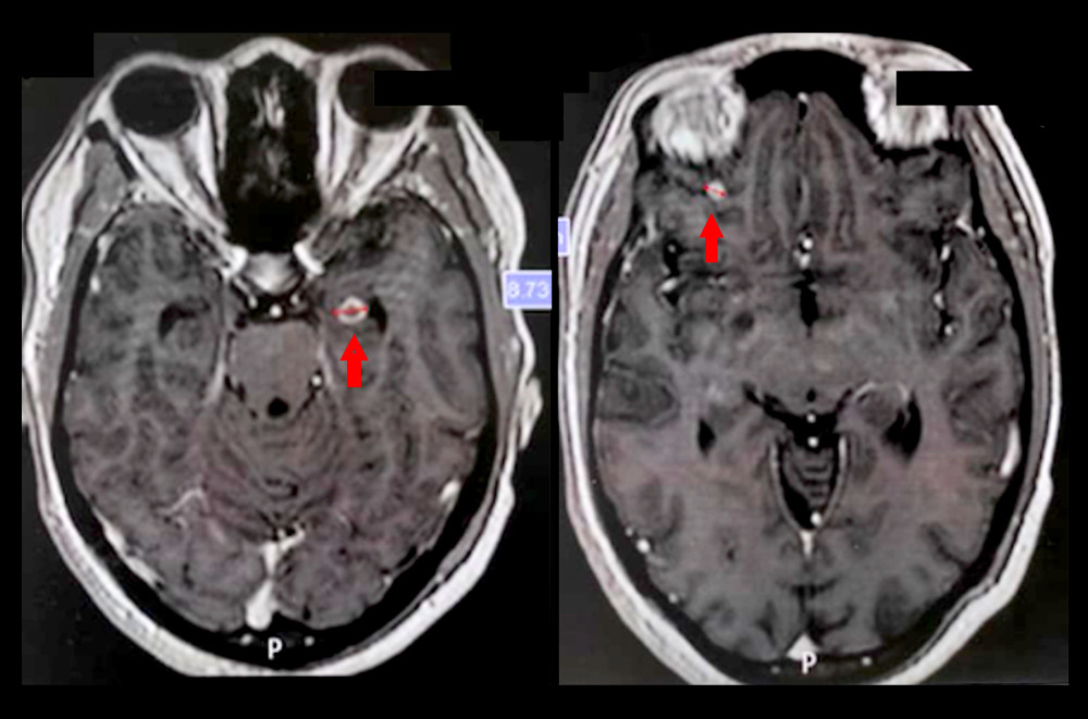 Magnetic resonance T1 image section cross showing tuberculomas (red arrows) in the left temporal lobe and the other in the right frontal lobe, both measuring approximately 10 mm.