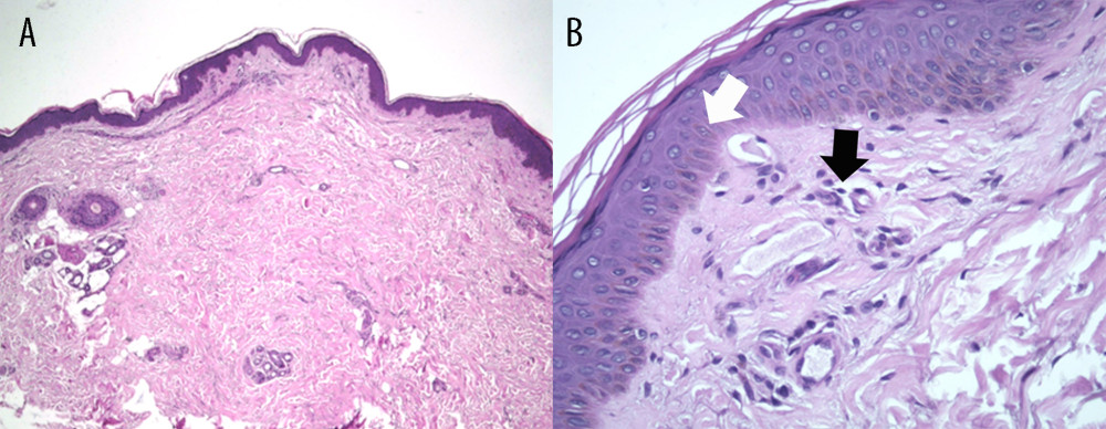 Pathological examination of the skin with hematoxylin-eosin staining. (A) On 40× magnification there was keratinized stratified squamous epithelium with a foci of flattened basement membrane. (B) On 400× magnification there were epidermis with spongiosis (white arrow) and dermis with stromal elastosis, as well as visible congestive blood vessel with mild lymphocytic inflammatory cells (black arrow). There were no eosinophil or necrotic cells seen in the epidermis and dermis.