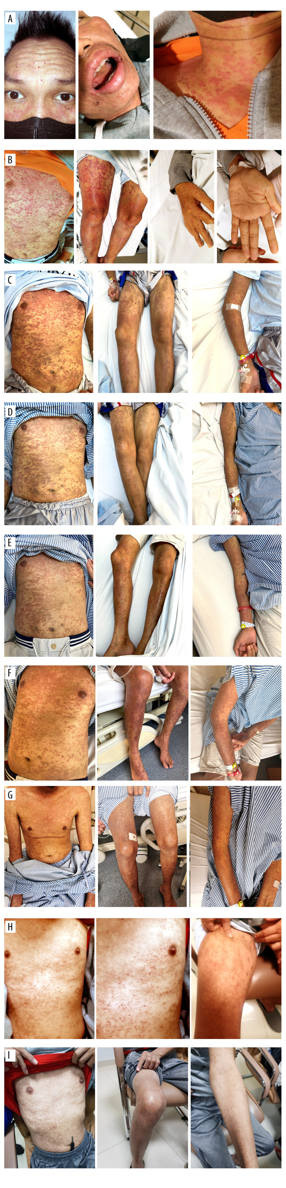 Development of skin lesions. (A, B) Day 1. There were generalized erythematous macules and papules, with palpable petechia and purpura. There were no lesions in the mouth, eyes, or genitalia. (C) Day 2. (D) Day 3. (E) Day 6. (F) Day 7. (G) Day 10. (H) Day 15. The generalized erythematous macules became hyperpigmented, and there were fewer petechia and purpura. (I) Day 30. There were only hyperpigmented patches on the skin, and the petechia and purpura had resolved.