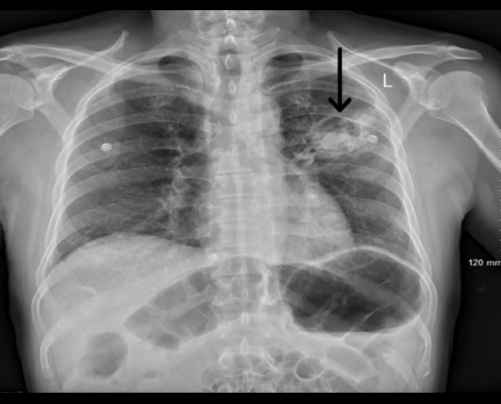 Chest X-ray on Day 1 of admission showing bilateral patchy opacities and possible cavitary lesions in left upper lobe.