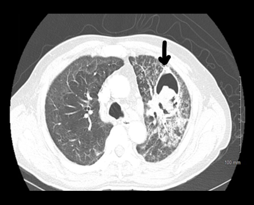 Chest CT scan showing thick walled cavitary lesion in the left upper lobe with soft-tissue density within the cavity and areas of focal consolidation.