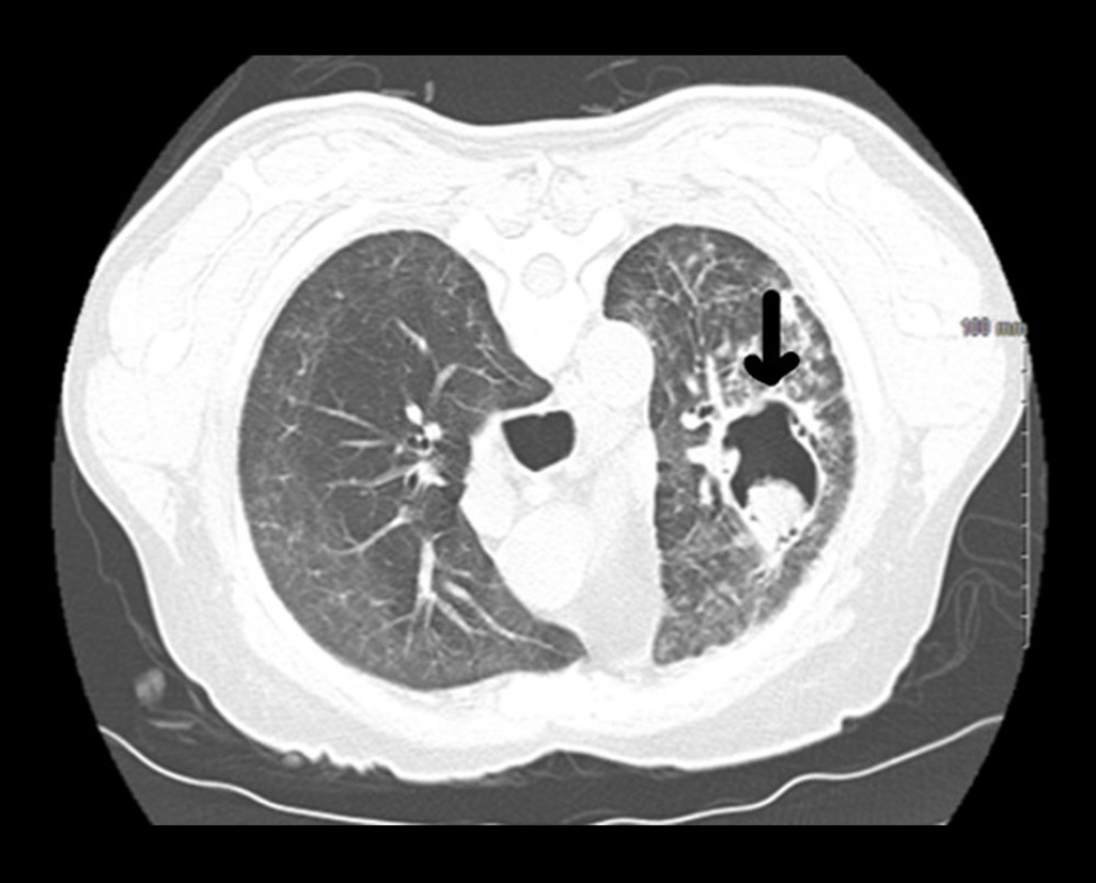 CT scan of the chest showed the mass within the cavity moved to the ventral wall of the cavity in the prone position.