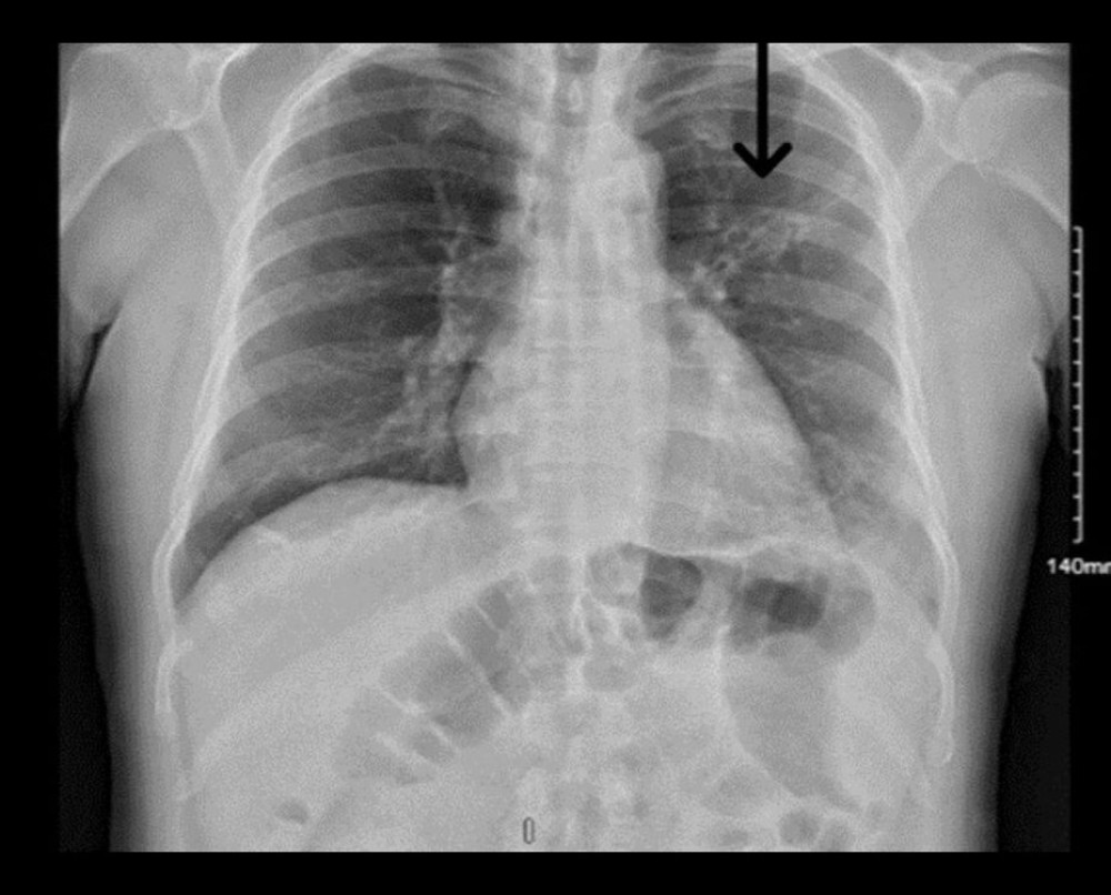 Chest X-ray at 7 months of Itraconazole therapy showing marked decrease in left upper-lobe opacities.