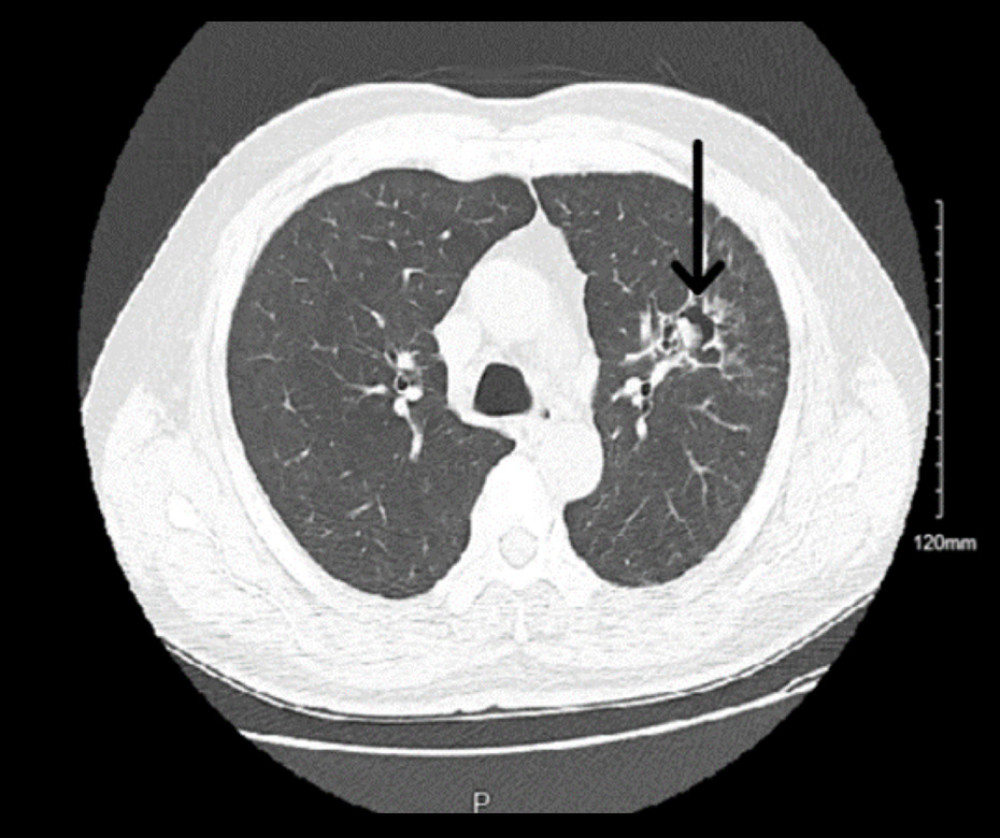 CT scan of the chest at 9 months of Itraconazole treatment showing resolution of previously extensive airspace disease with decrease in the size of the upper-lobe cavity and fungal ball.