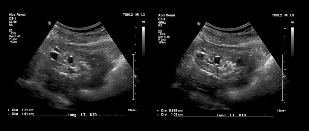 Renal ultrasound of left kidney demonstrating multiple cysts. The renal ultrasound was performed 10 years after the original cTMA diagnosis as part of a surveillance followup. cTMA – complement-mediated thrombotic microangiopathy.