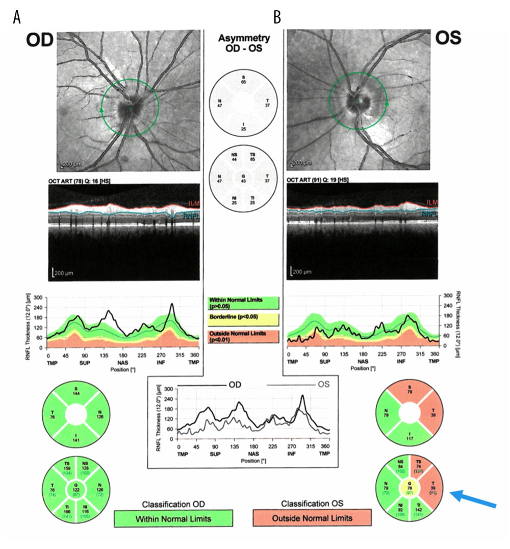 Optical coherence tomography of optic nerve head. (A) Right eye, demonstrating retinal nerve fiber layer (RNFL) thickening, superiorly, nasally, and inferiorly, sparing the temporal side, which is consistent with grade 1 optic disc edema. (B) Left eye, demonstrating superotemporal and temporal RNFL thinning (arrow), which is consistent with the patient’s inferonasal field defect.