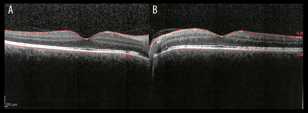 Optical coherence tomography of the macula. (A) Right eye, no intraretinal or subretinal fluid. Preserved outer and inner retinal layers. (B) Left eye, no intraretinal or subretinal fluid. Preserved outer and inner retinal layers.