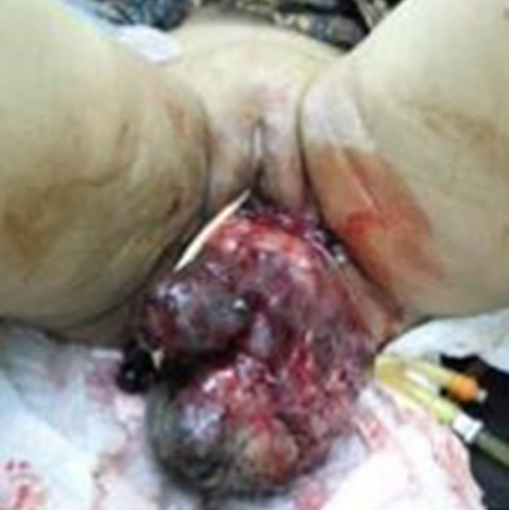 Vaginal mass, humped, brittle.