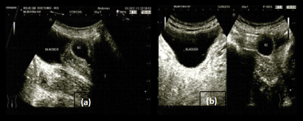 Ultrasound view of the abdomen, (a) sagittal slice, (b) transverse slice.