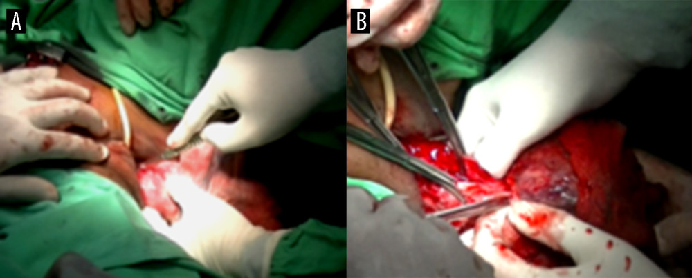 (A, B) Vaginal approach: anterior uterine wall incision presented.