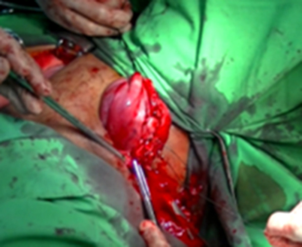 Vaginal approach: suture to the uterine wall incision presented.