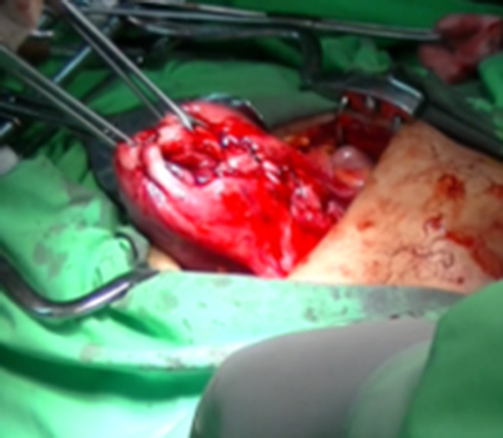 Abdominal approach: uterus after repositioning the cavum abdomen.