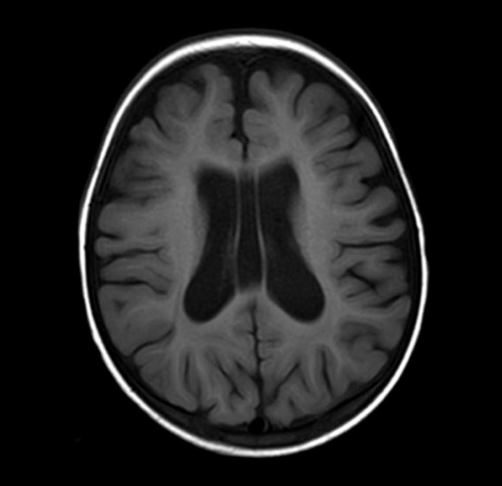 Brain magnetic resonance imaging (MRI) at age 25 months. Brain MRI shows dilated ventricular and mild brain atrophy. This figure is an original image.