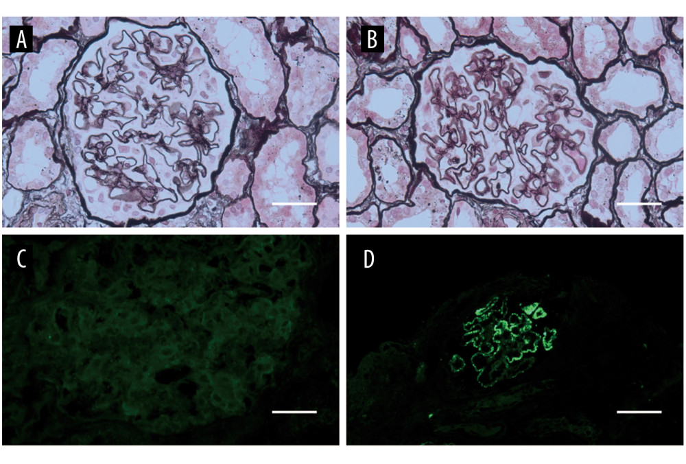The second renal biopsy and histopathology of the patient in 2013. (A, B) Thickened glomerular basement membrane, normal mesangial cellularity (PASM ×400) (C, D) Immunofluorescence microscopy revealing negative findings for IgA and (++) findings for IgG1 (immunofluorescence ×400 and ×100). PASM – periodic Schiff-Methenamine.
