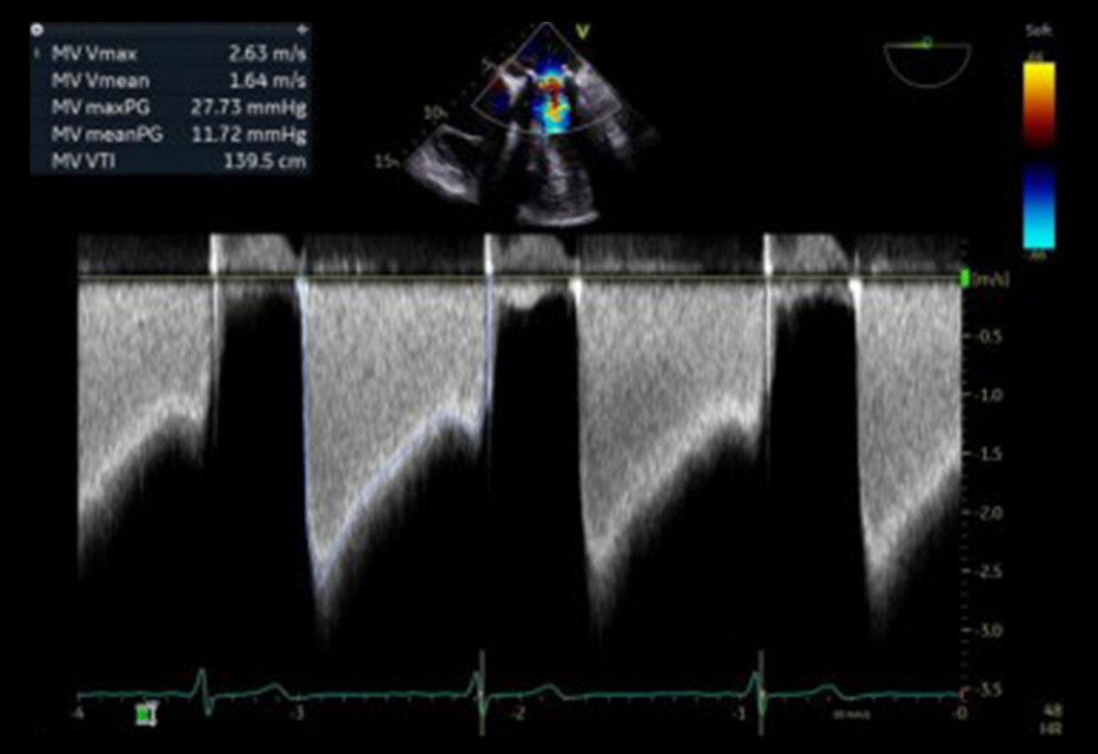 Pre-procedure transesophageal echocardiogram (TEE): Continuous wave inflow Doppler of mitral valve on TEE showing severe stenosis of bioprosthetic mitral valve with a mean gradiant of 11.72 mmHg.
