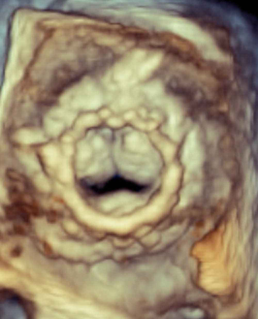 Three-dimensional image of severely stenotic bioprosthetic mitral valve on pre-deployment transesophageal echocardiogram: Surgeon’s view from the left atrium showing severe leaflet restriction with severely reduced valve opening.