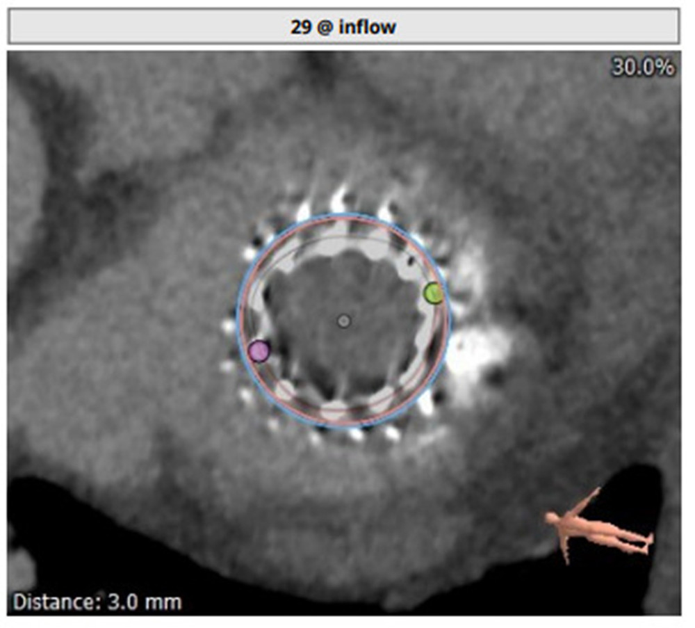 Computed tomography assessment of mitral valve: To assess annular size and to determine appropriate size of the new valve.