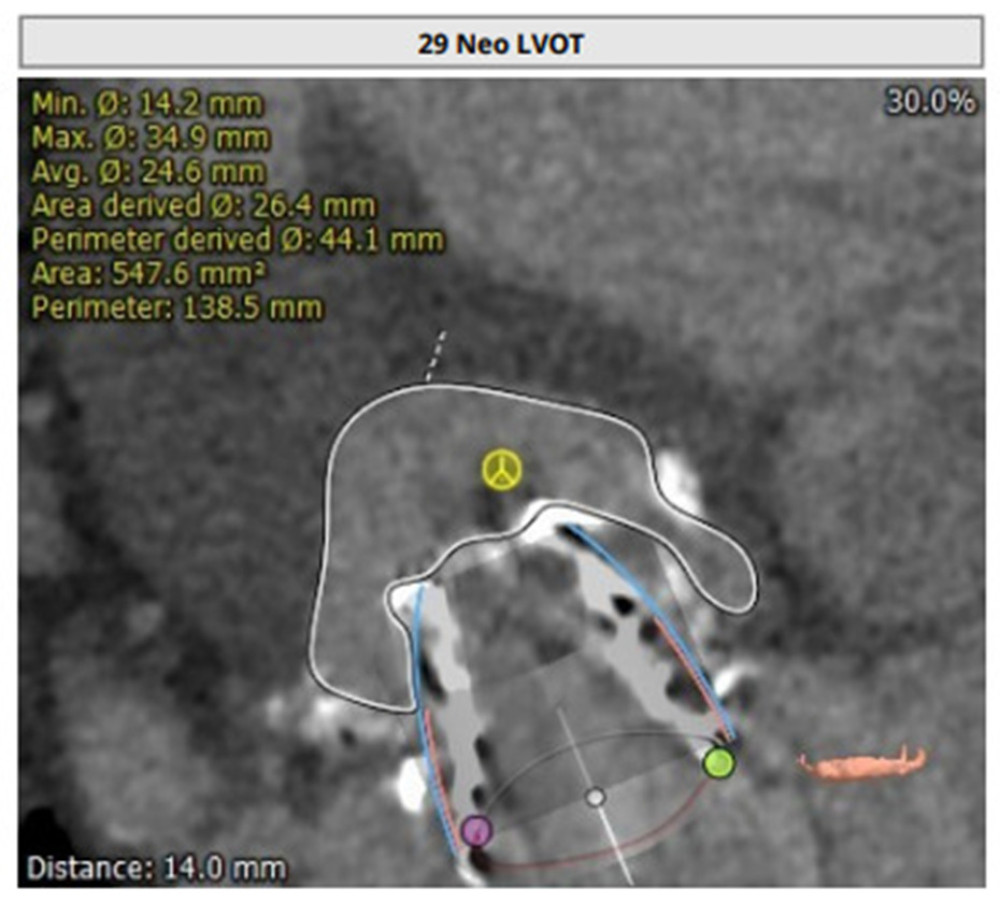 Computed tomography assessment of neo left ventricular outflow tract (LVOT): Shows average area of 26.44 mm after valve implantation, which would be low risk for LVOT obstruction.