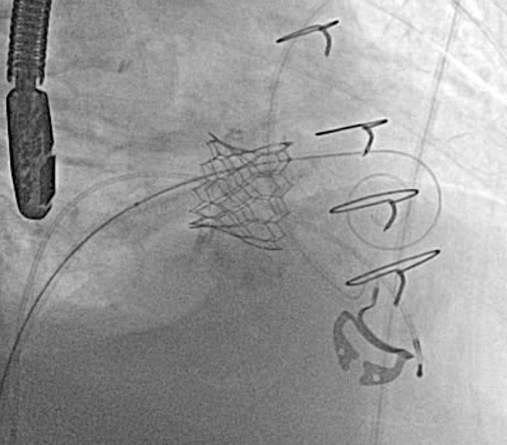 Prior to dilation: Fluoroscopy shows overlapping previously deployed valve stent struts.