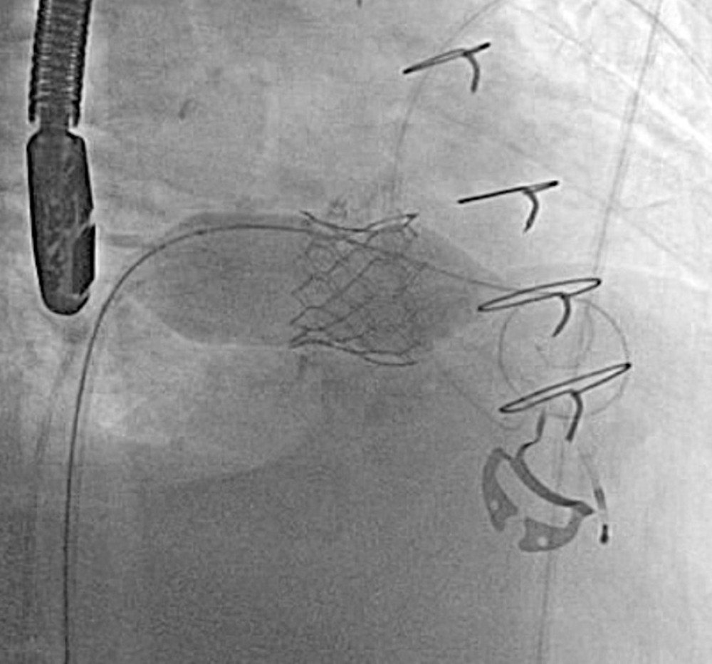 Persisting waist: Fluoroscopy shows significant waist after initial balloon inflation.