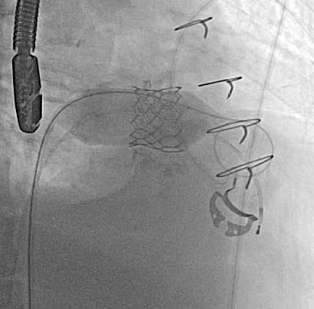 After dilation: Fluoroscopy shows resolution of waist and fracture of the stent struts after high pressure inflation of the balloon.