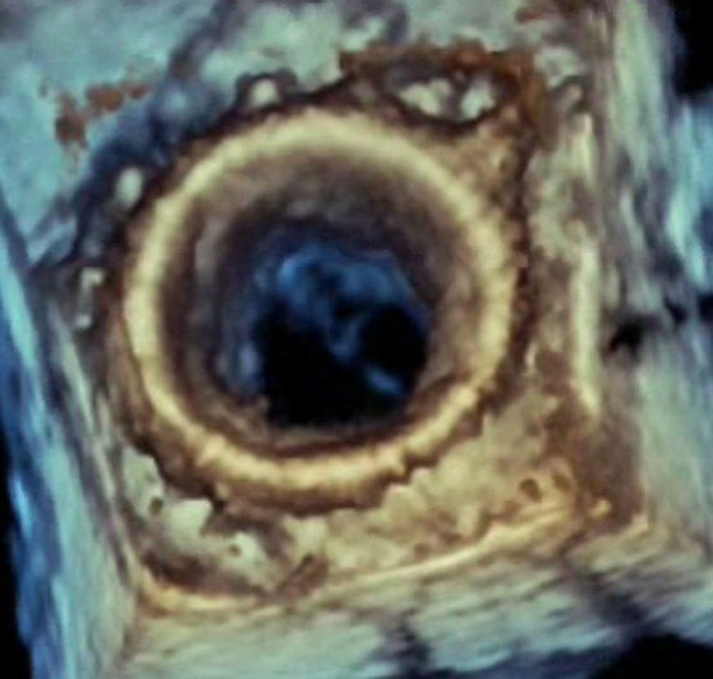 Three-dimensional image of bioprosthetic mitral valve on post-deployment transesophageal echocardiogram: Surgeon’s view showing successful placement of the new bioprosthetic mitral valve with full leaflet opening and improved valve area, as compared with Figure 2.