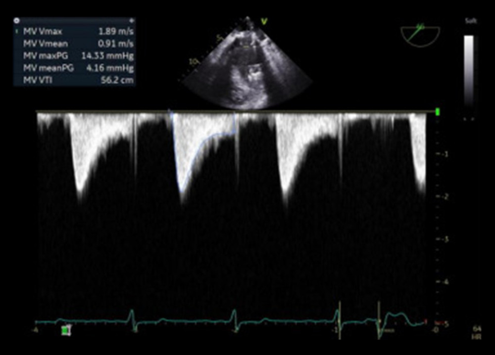 Post-procedure transesophageal echocardiogram: Continuous wave inflow Doppler of mitral valve post-deployment showing resolution of severe stenosis and an improved mean gradient of 4.16 mmHg.