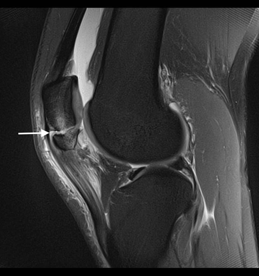Sagittal view magnetic resonance imaging (MRI) demonstrating a displaced inferior pole fracture of the left patella (arrow).