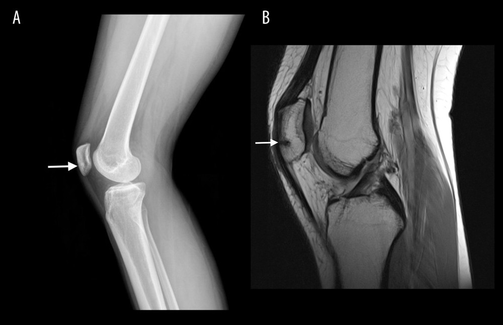 (A) Sagittal view X-ray image demonstrating a stress reaction at the inferior pole of the right patella (arrow). (B) Sagittal view magnetic resonance imaging (MRI) demonstrating a stress reaction at the inferior pole of the right patella (arrow).
