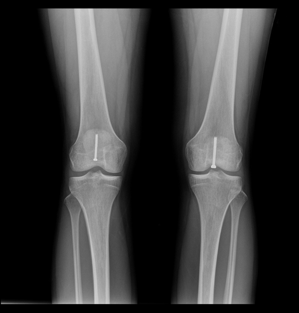 Frontal X-ray image of bilateral knees, each with 1 partially-threaded cancellous screw, 2 months following right patellar fixation.