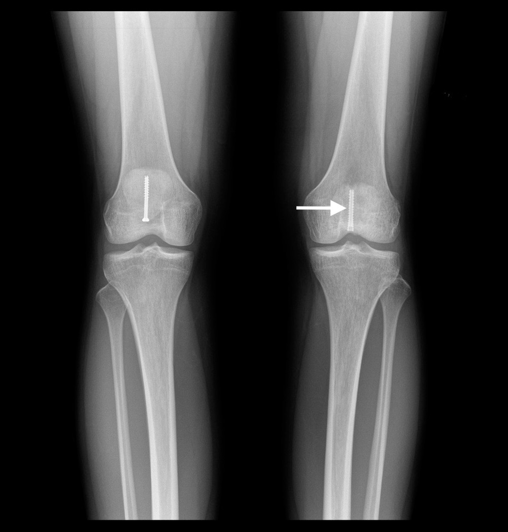 Frontal X-ray image of the final screw placement 1 month following replacement of the partially-threaded cancellous cannulated screw in the left patella with a headless compression screw (arrow).