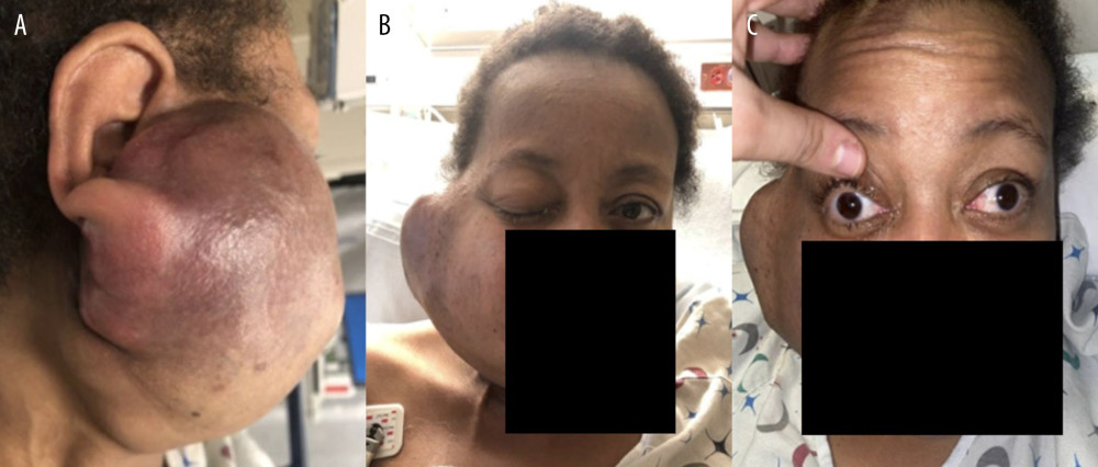 Photographs of large facial mass in a 51-year-old woman with HIV, which was diagnosed as extramedullary plasmacytoma. (A) Lateral view of the right facial mass demonstrates violaceous skin changes. (B) Anterior view of the patient’s face shows right facial mass and right eye ptosis. (C) Anterior view of patient’s face, with right eye held open, displays the right eye ophthalmoplegia.