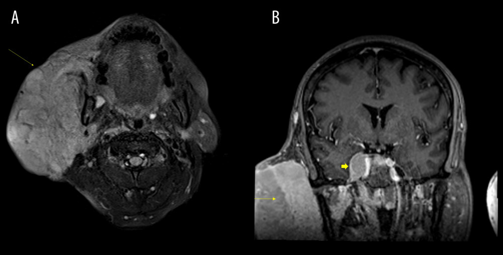Magnetic resonance imaging of parotid mass, which was diagnosed as extramedullary plasmacytoma. (A) Axial T2 FLAIR demonstrates large right intraparotid mass. (B) T1 coronal images after gadolinium demonstrates enhancement of the right intraparotid mass (arrow) and enhancing soft tissue mass in the right cavernous sinus (block arrow).