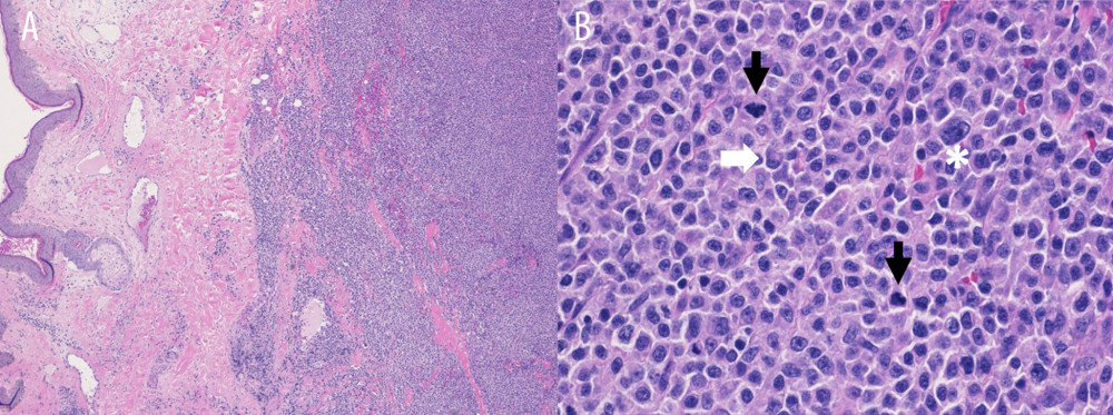 Photomicrographs of parotid mass incisional biopsy with hematoxylin and eosin staining, supporting the diagnosis of extramedullary plasmacytoma. (A) Slides of skin and underlying soft tissue (left) show an infiltrative, dense, monotonous, population of large atypical lymphoid cells (right) under 4× magnification. (B) At 40× magnification, large, atypical, lymphoid cells with open chromatin, prominent nucleoli, and moderate amount of pale blue cytoplasm are seen. Both plasmacytic (white arrow) and plasmablastic morphology (white star) are noted in these atypical cells with eccentric nuclei. Frequent mitotic figures are also noted (black arrows).