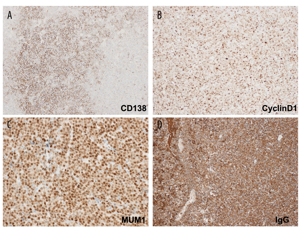 Immunohistochemical stain of large parotid mass incisional biopsy, which was diagnosed as extramedullary plasmacytoma. Atypical lymphocytes showing positivity (brown coloration) for (A) CD138, (B) Cyclin D1, (C) MUM1, and (D) IgG are seen here at 40× magnification.