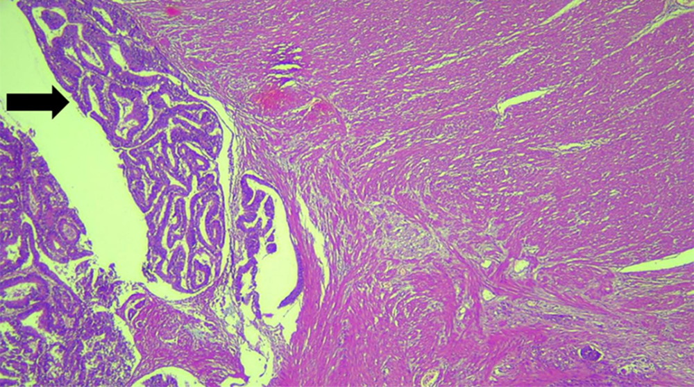 Histopathology at 40× magnification of the hematoxylin-eosin-stained specimen reveals that a well-differentiated sigmoid tumor adenocarcinoma has infiltrated the tunica muscularis propria.