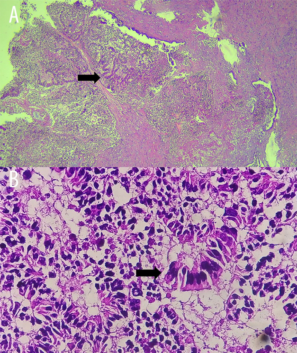 The hematoxylin-eosin-stained specimen showed the adenocarcinoma metastasized to the liver. Tumor infiltration of liver tissue is seen at both (A) low (40×) and (B) high (400×) magnifications.