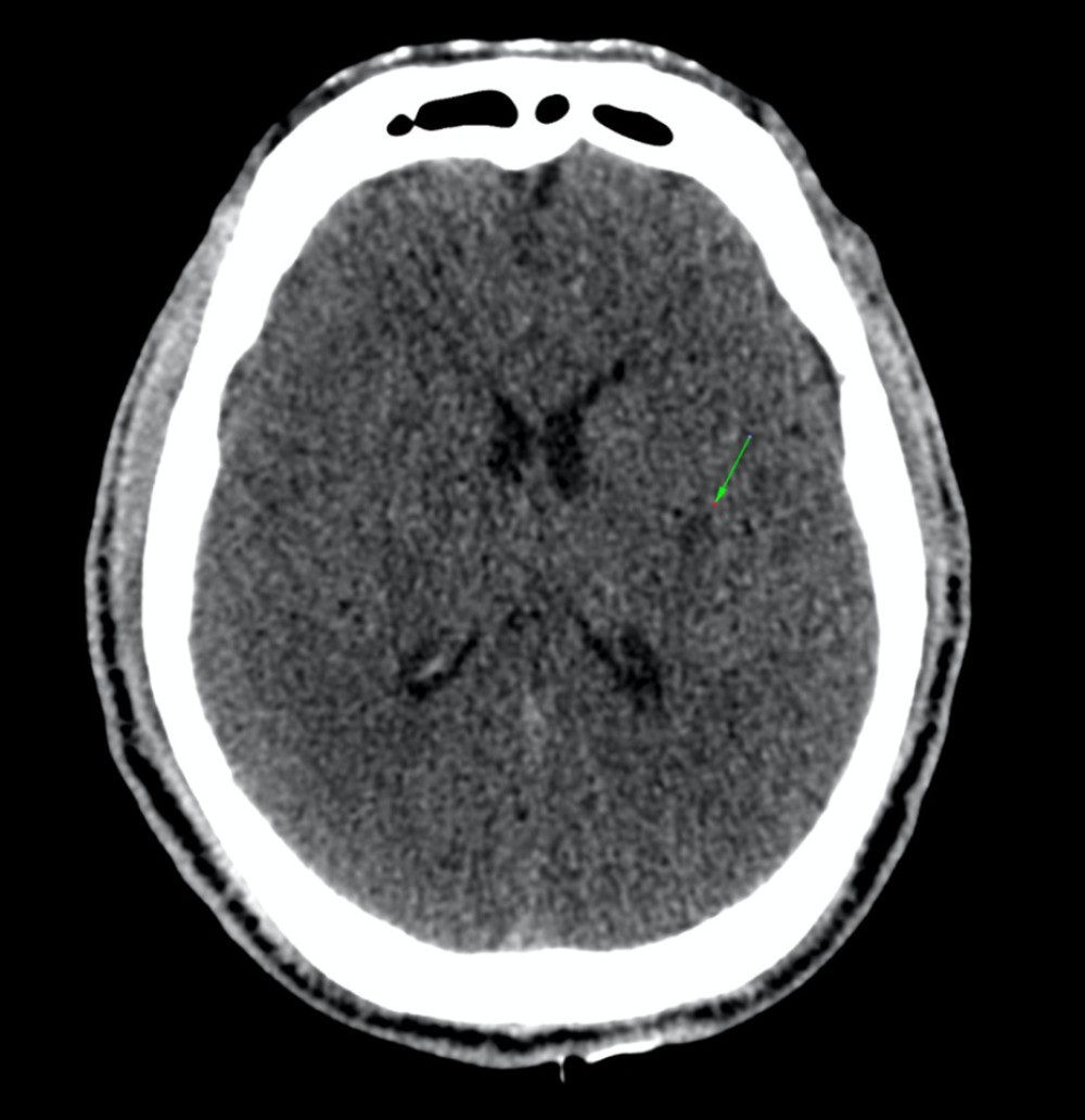 Multislice computed tomography scan of the brain. White arrow indicates an old infarction in the left external capsule region.