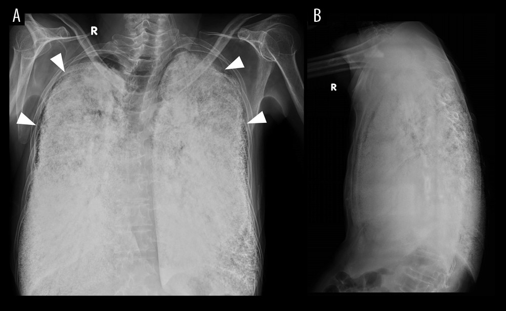 (A, B) Chest X-ray. Chest X-ray with posteroanterior and lateral view shows a pattern of diffuse opacity of high density with symmetrical and bilateral micronodular patterns. Notice the subpleural lucency in keeping with the black pleural line (arrow head).