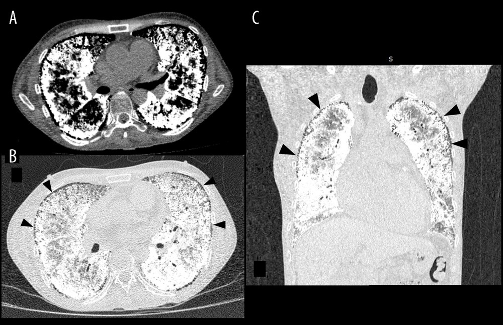 Chest HRCT. Reconstructed plane of axial and coronal with mediastinal (A) and lung (B, C) window of HRCT revealed diffuse micronodular calcification along the interlobar septa and subpleural regions in the lower pulmonary regions, with ground-glass attenuation and septal thickening in between. Multiple cysts were also noticed along the subpleural line (arrow head).
