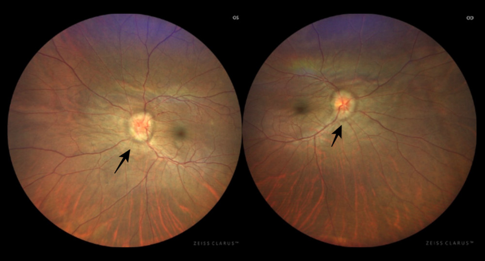 Fundus photo showing bilateral choroidal folds with bilateral optic nerve edema grade 4.