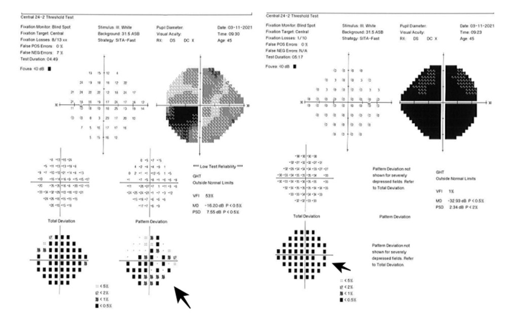 24-2 Humphrey visual field test on presentation showing total visual field defect for right eye and subtotal defect for left eye.