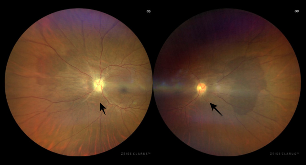 Fundus photo, 4 weeks after 4th tocilizumab injection showing resolving bilateral disc edema.