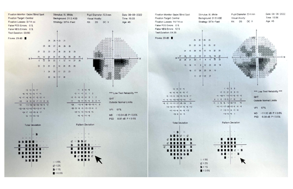 24-2 Humphrey visual field test, 4 weeks after fourth dose of tocilizumab injection.